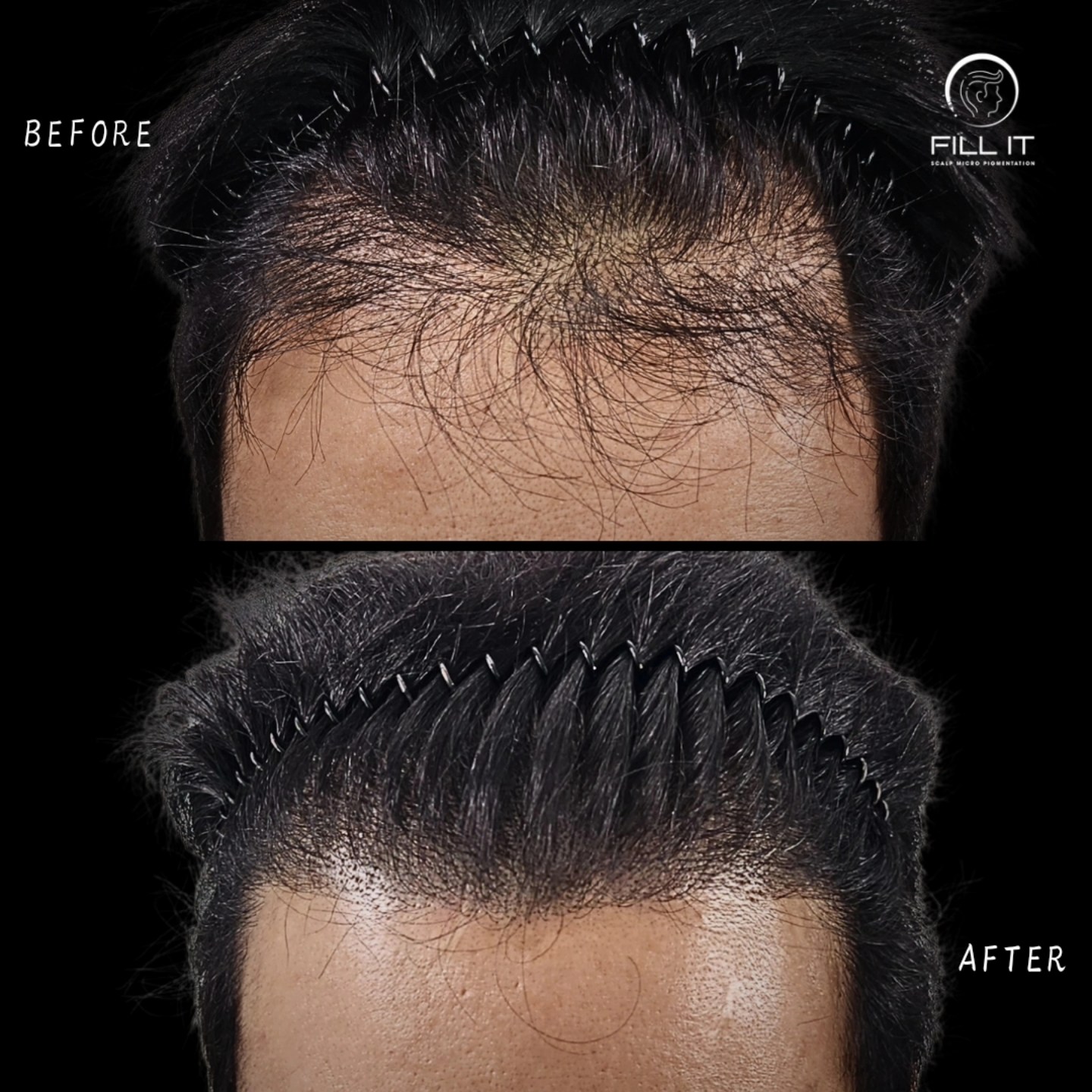 FILL IT_smp Facebook ad: Hair transplant alone isn’t enough!
