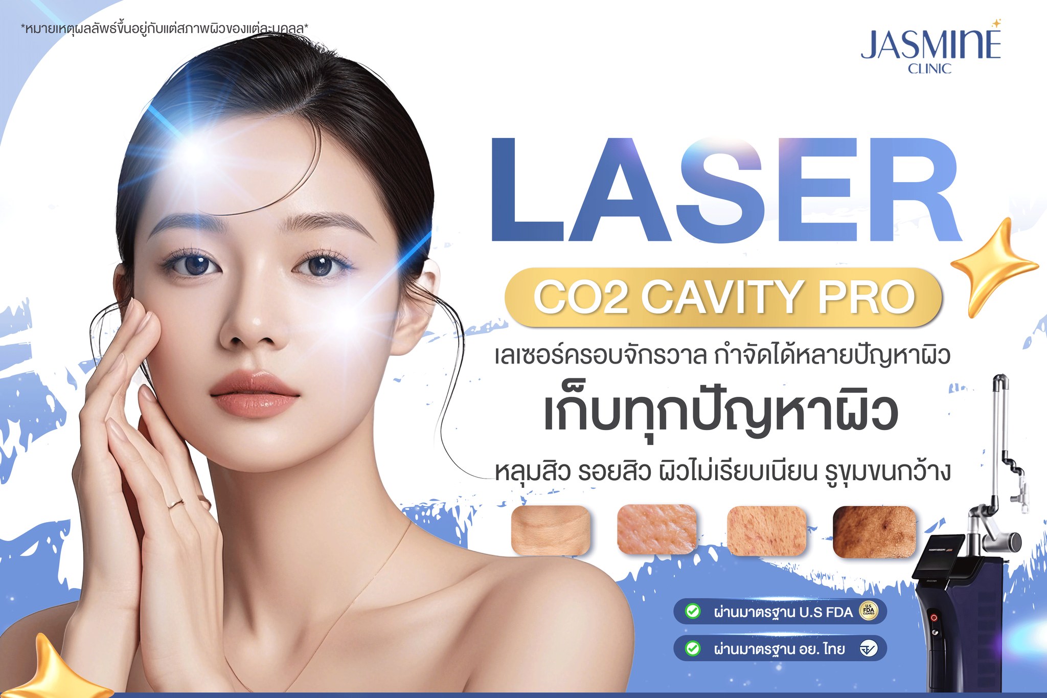 จัสมินคลินิก เชียงราย Facebook ad: หมดปัญหากวนใจด้วย Laser CO2 Cavity Pro