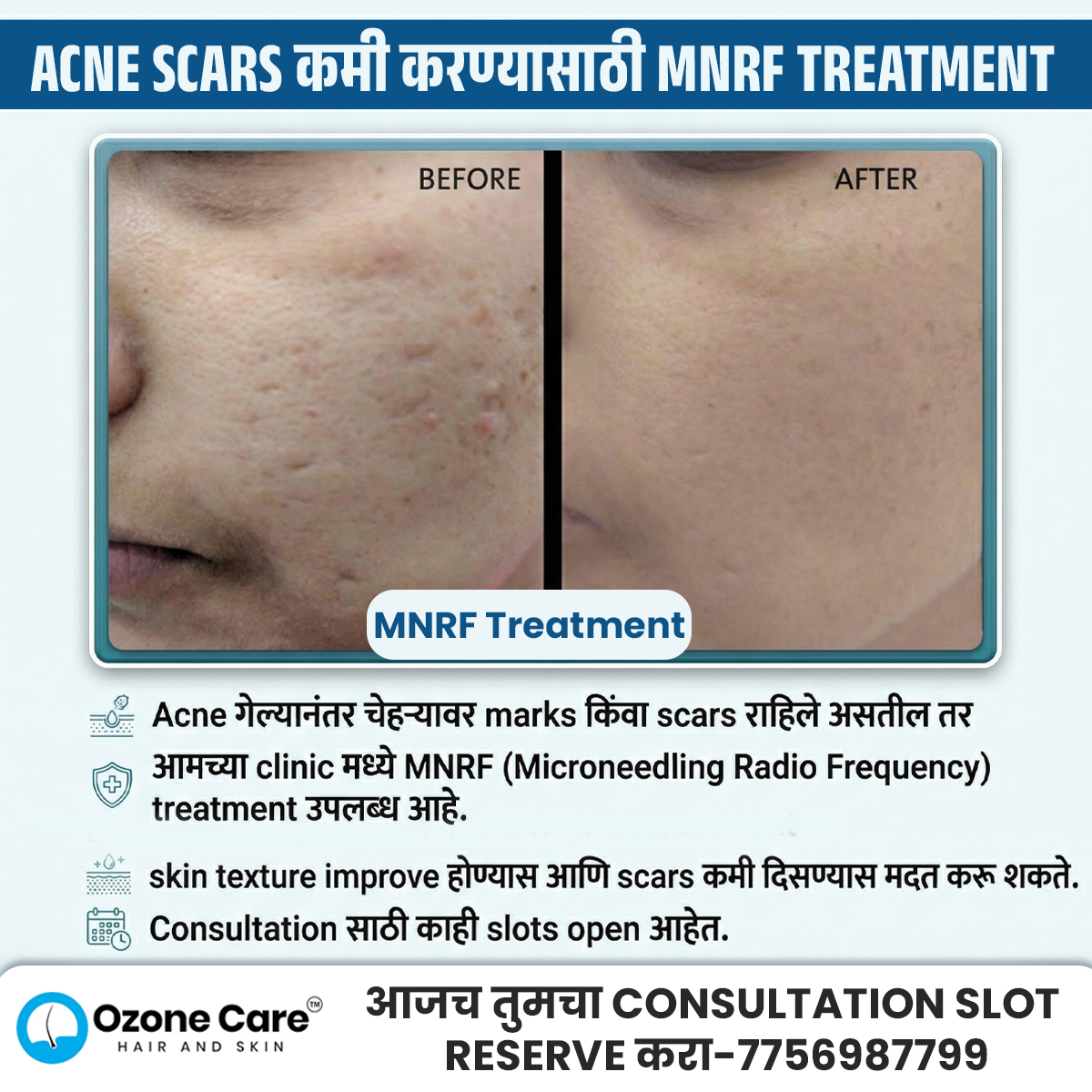 Ozone Care Clinic Seawoods, Navi Mumbai Facebook ad: Acne Scar Consultation