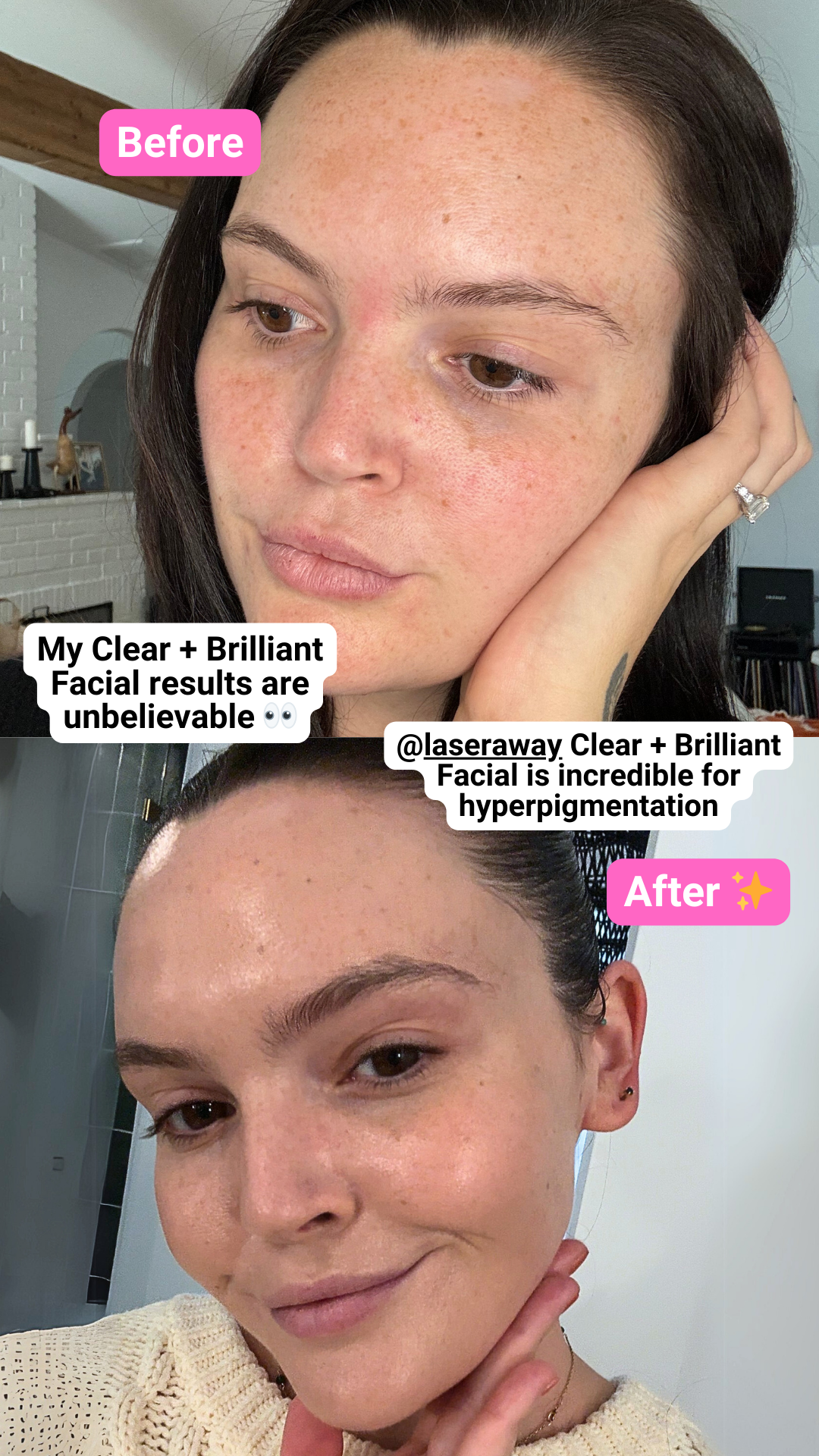 LaserAway Facebook ad