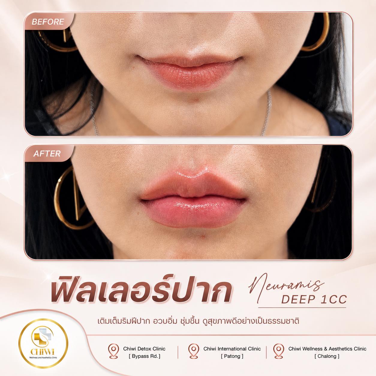Chiwi International Clinic Facebook ad: เติมปากสวยละมุน อวบอิ่มแบบธรรมชาติ