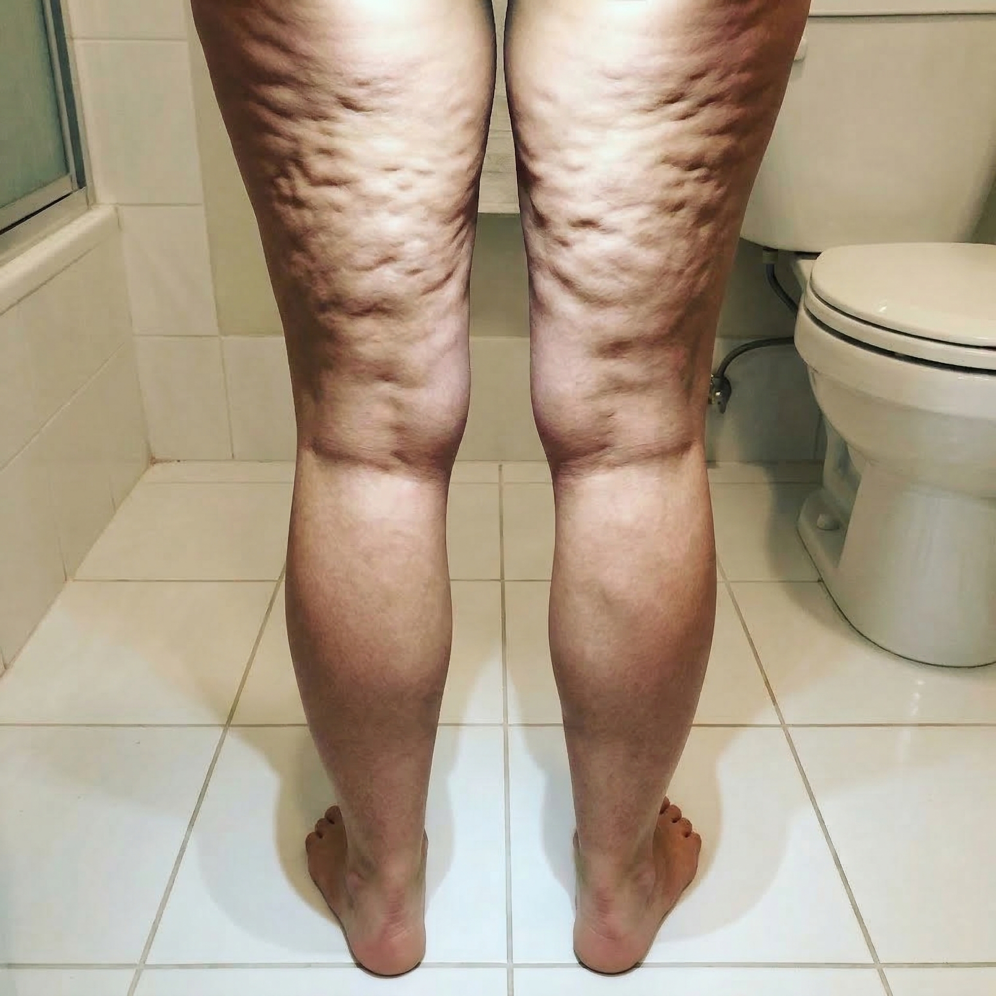 Susan Miller Facebook ad: I've Been Hiding My Legs For 3 Years.