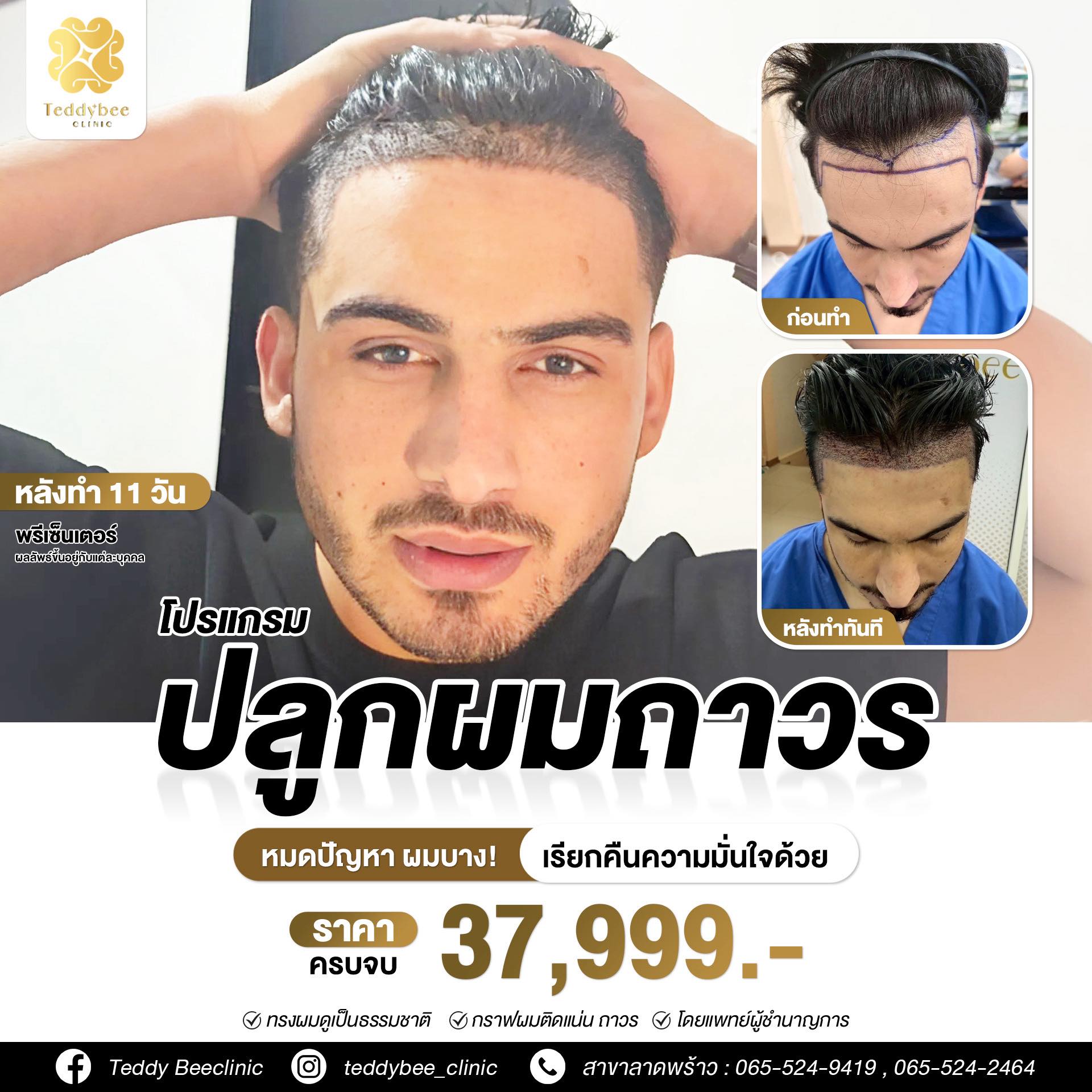 Teddy Beeclinic Facebook ad: หมดปัญหาผมบาง หน้าผากเว้าลึก คืนความมั่นใจให้คุณอีกครั้ง…