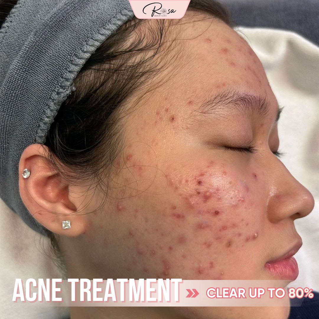 Rosa Beauty Clinic Facebook ad: Acne makes you lose confidence.