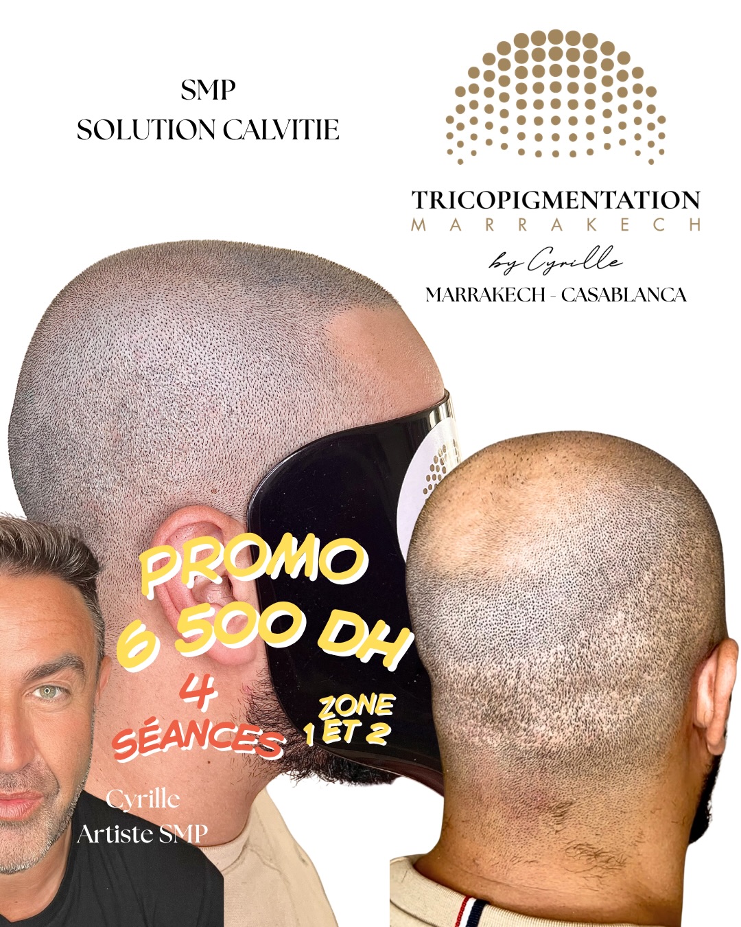 Tricopigmentation Marrakech. Facebook ad: L’expertise Tricopigmentation à Marrakech