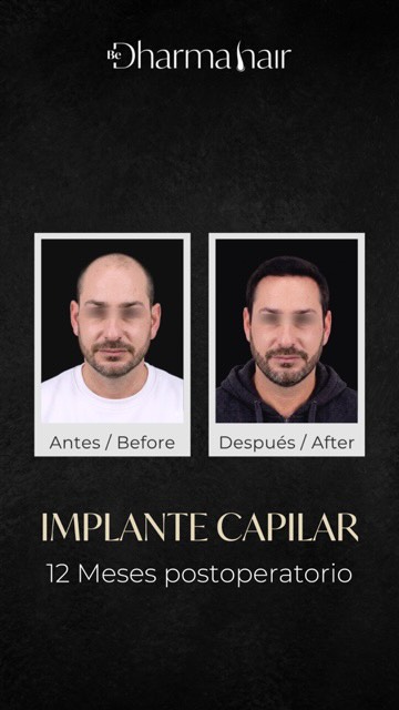Dharma Hair Facebook ad: Implante Capilar: Resultados de implante capilar en 12…