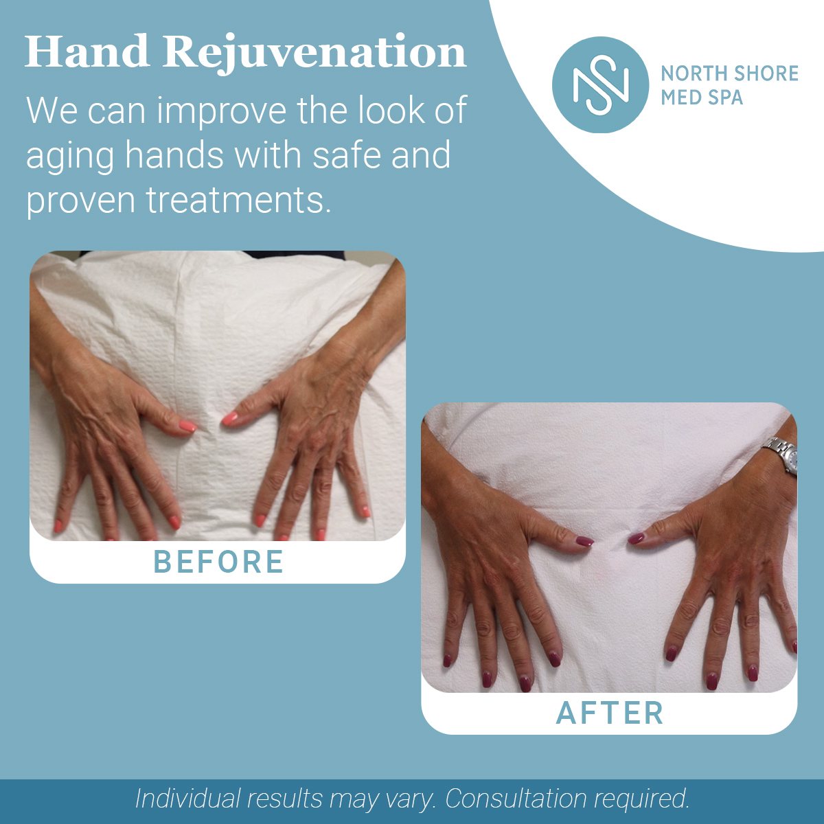 North Shore Med Spa Facebook ad: Restore Youthful Hands-Call Now