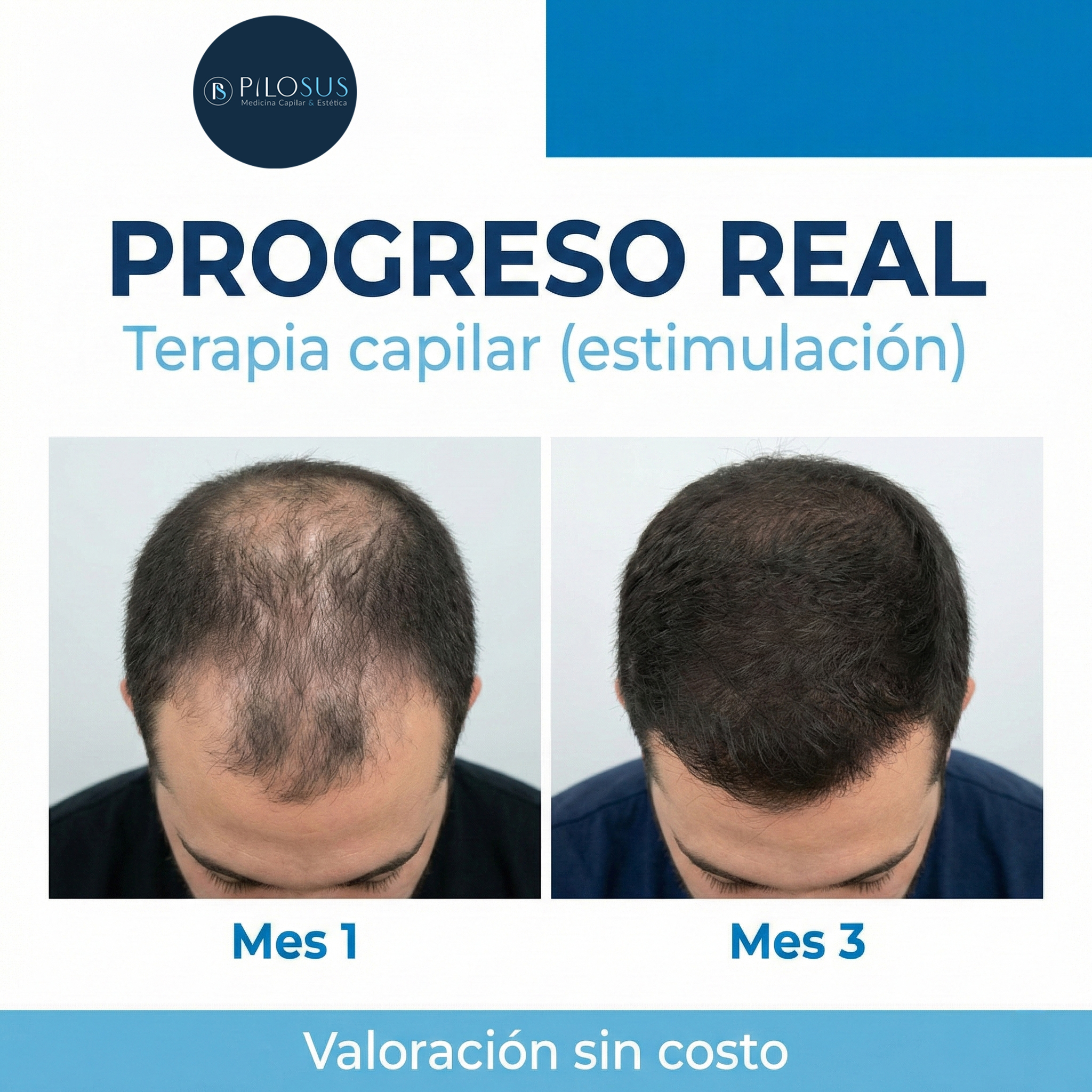 Pilosus Trasplante Capilar Facebook ad: Agenda tu valoración