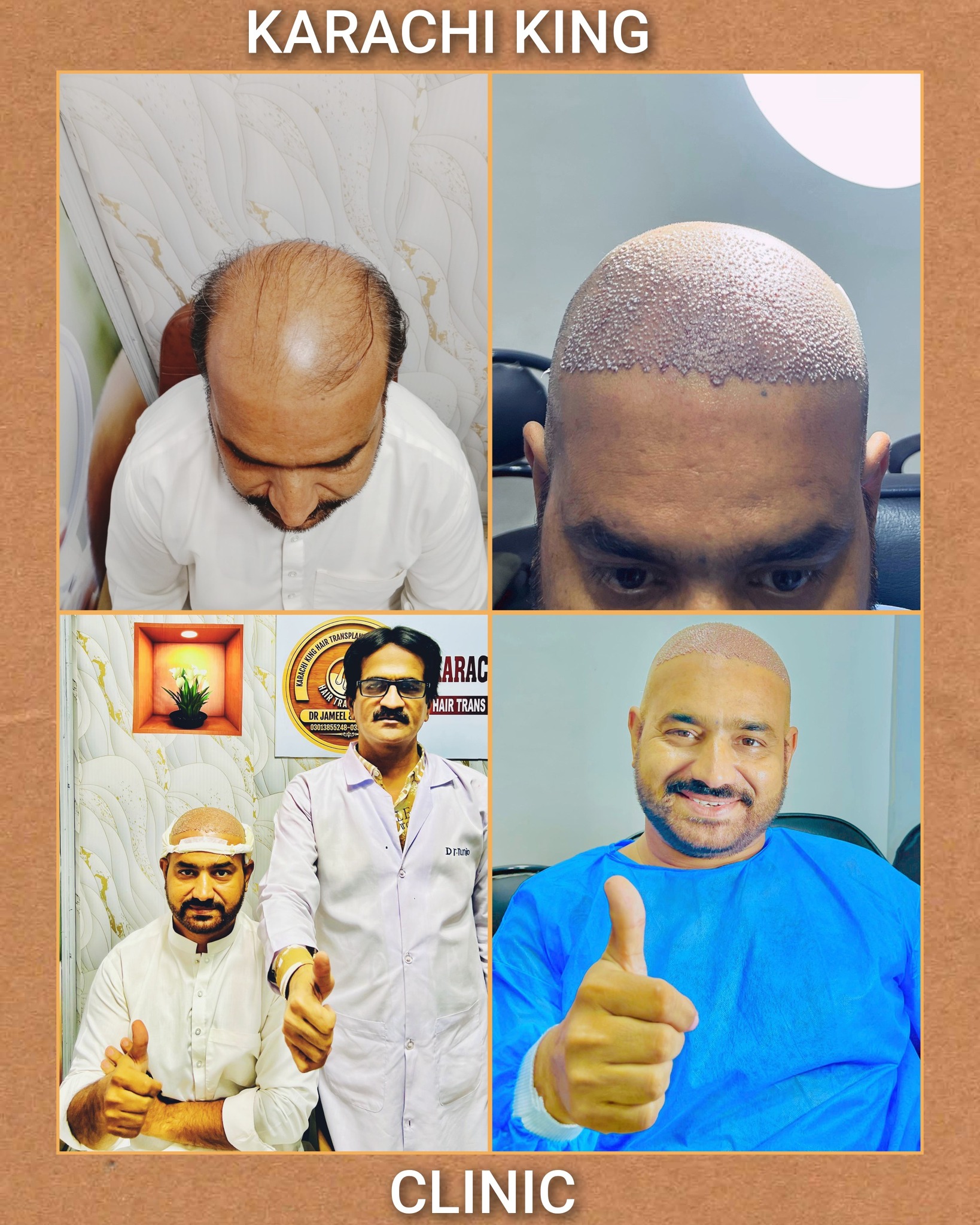 Karachi king skin care & hair transplant Facebook ad