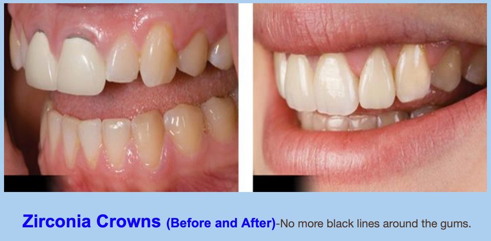 ProCare Family Dental Facebook ad: Metal-Free Dental Crowns