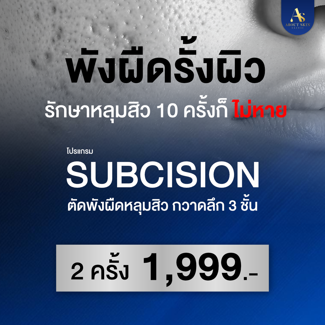 About Skin Clinic - สาขาเพชรเกษม 81 Facebook ad: ตัดพังผืด รักษาต้นตอหลุมสิว