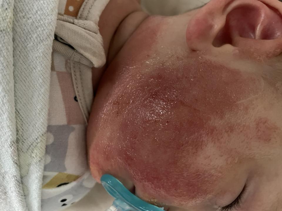 Jessica Rossi Facebook ad: Read this if your baby has eczema