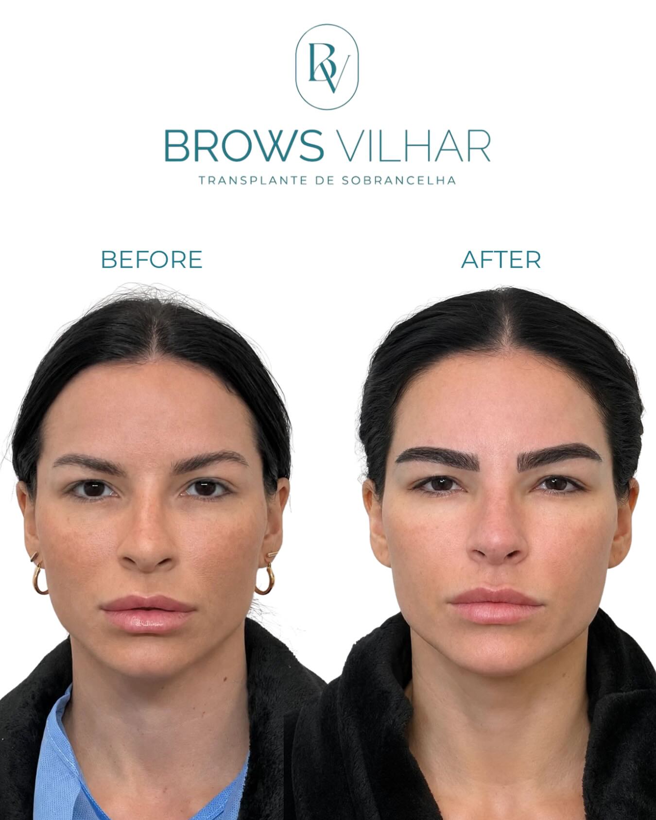 Daiane Facebook ad: Immediate post-op eyebrow transplant