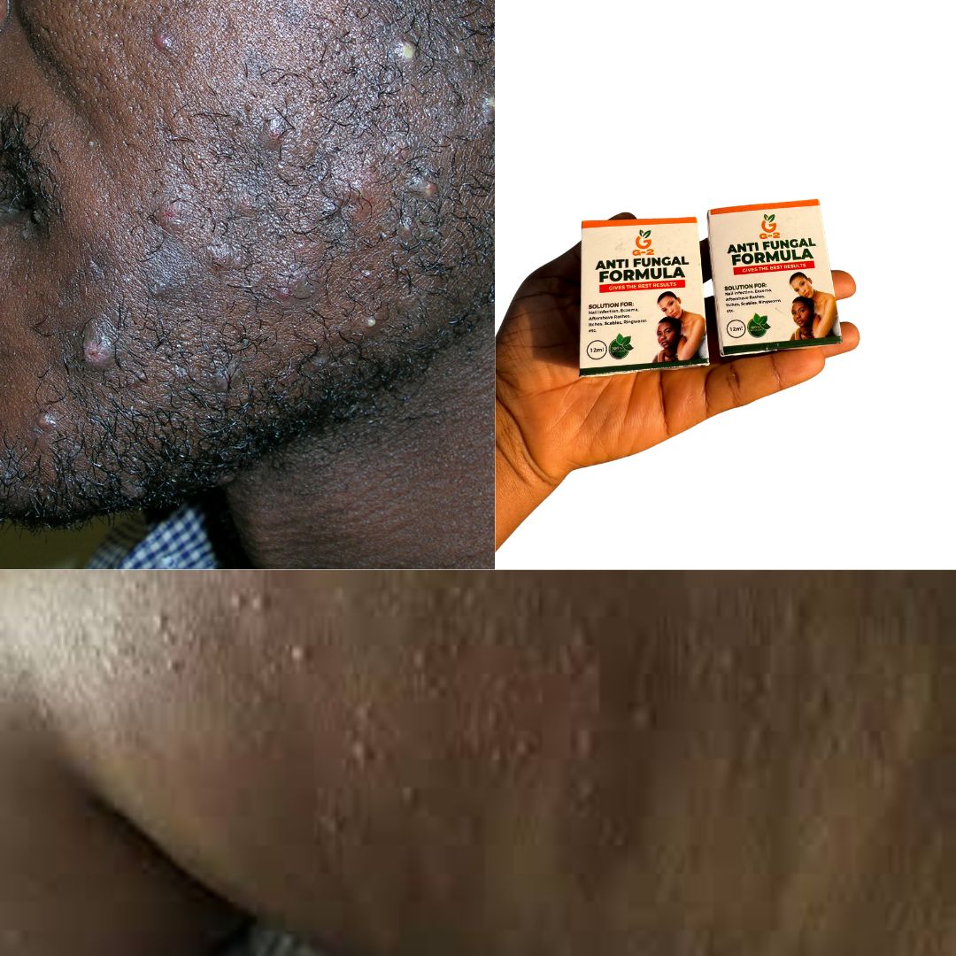 Fungal Natural Remedy Facebook ad
