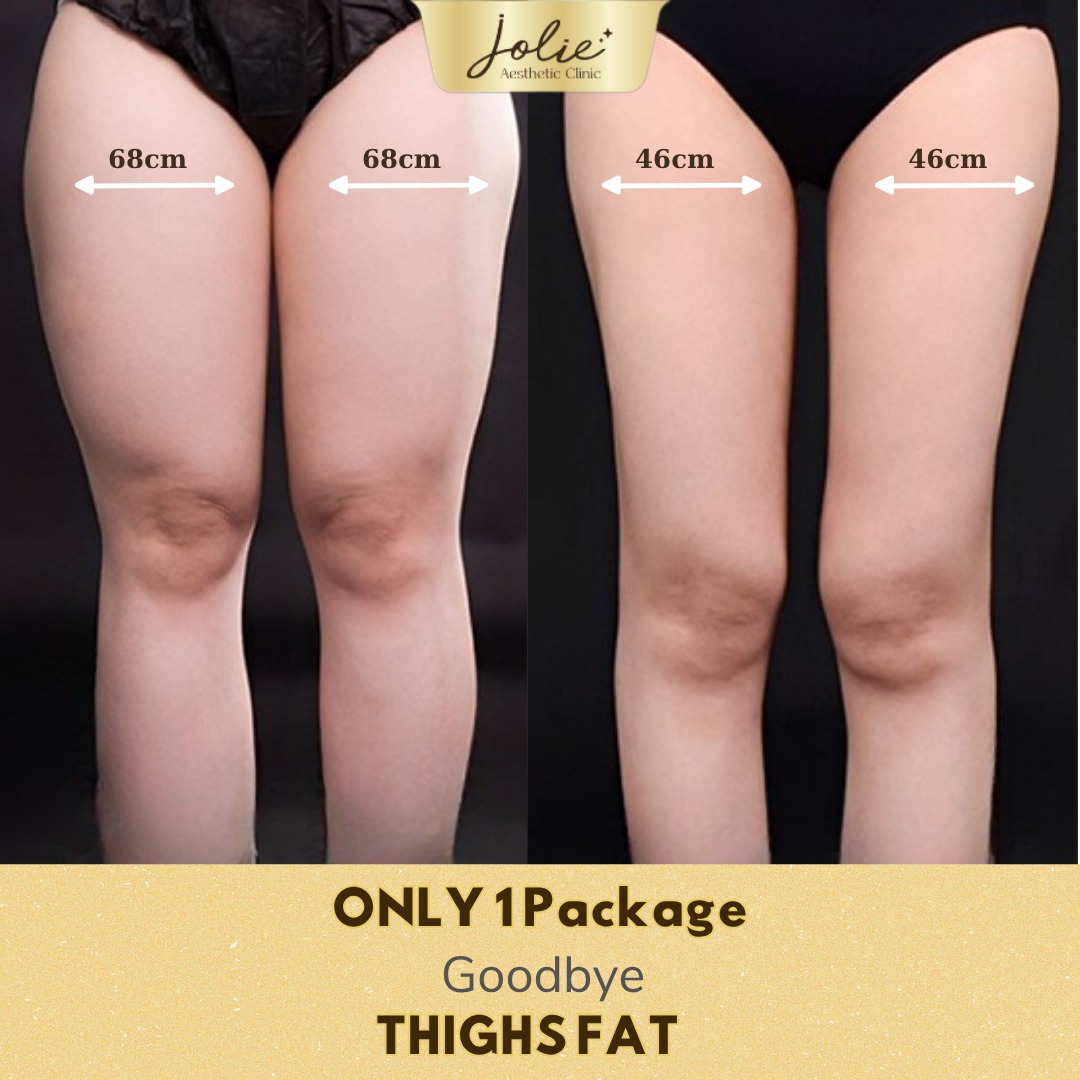 Jolie Ageless Beauty Johor Facebook ad: It’s not your thighs… it’s that you haven’t…
