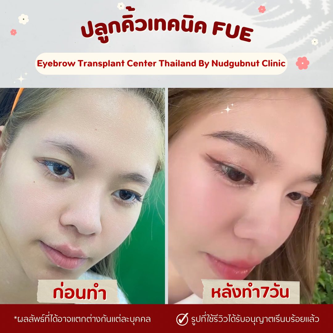 Eyebrow Transplant Thailand ปลูกคิ้ว นัดกับณัฐคลินิก Facebook ad: โปรโมชั่นรีวิว29,999.- จบ