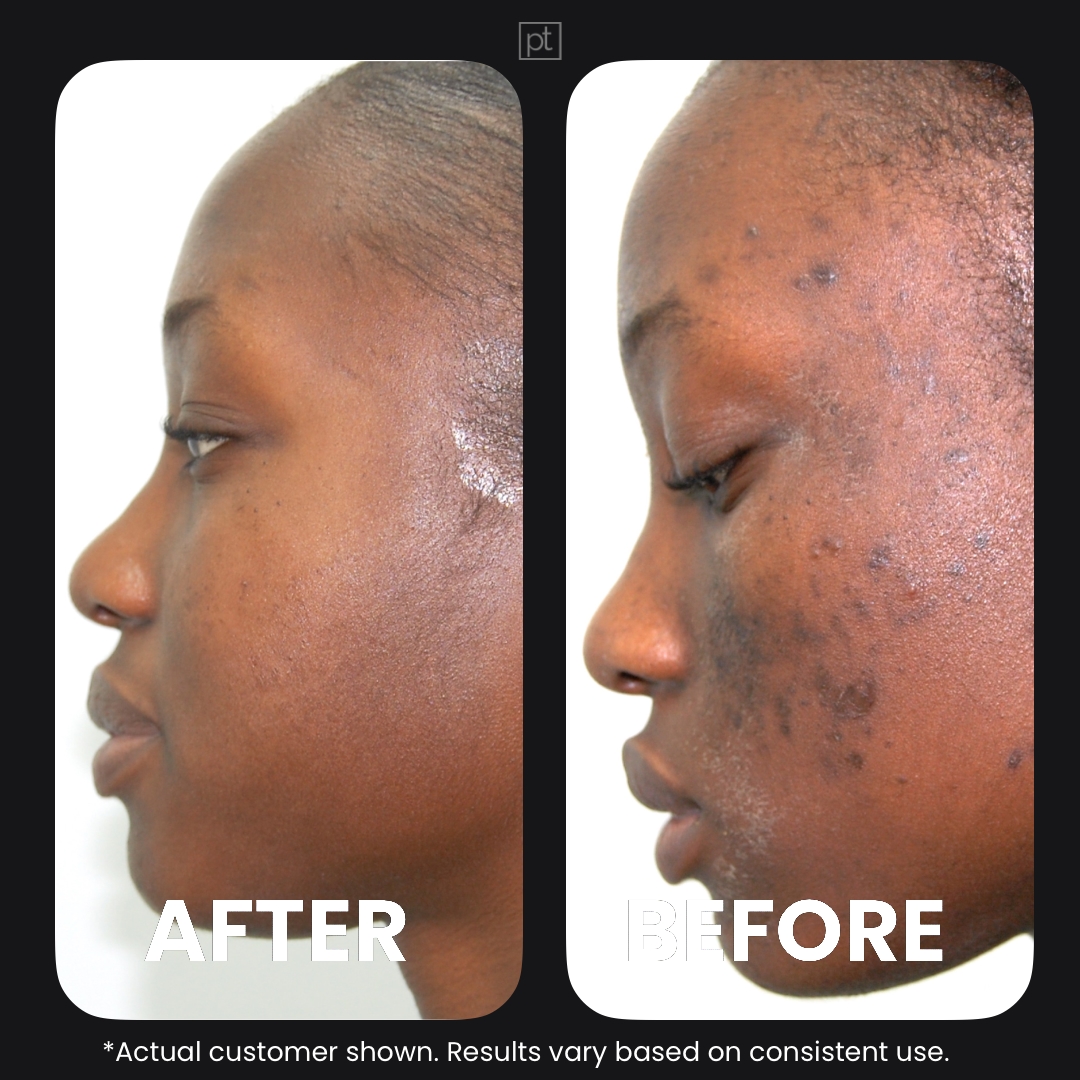 Perfec-Tone Facebook ad: Let Us Handle Your Skin