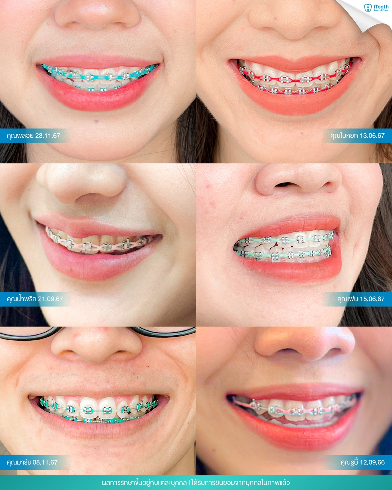 ITooth Dental Clinic จัดฟัน ฟอกสีฟัน รังสิต อ่อนนุช Facebook ad