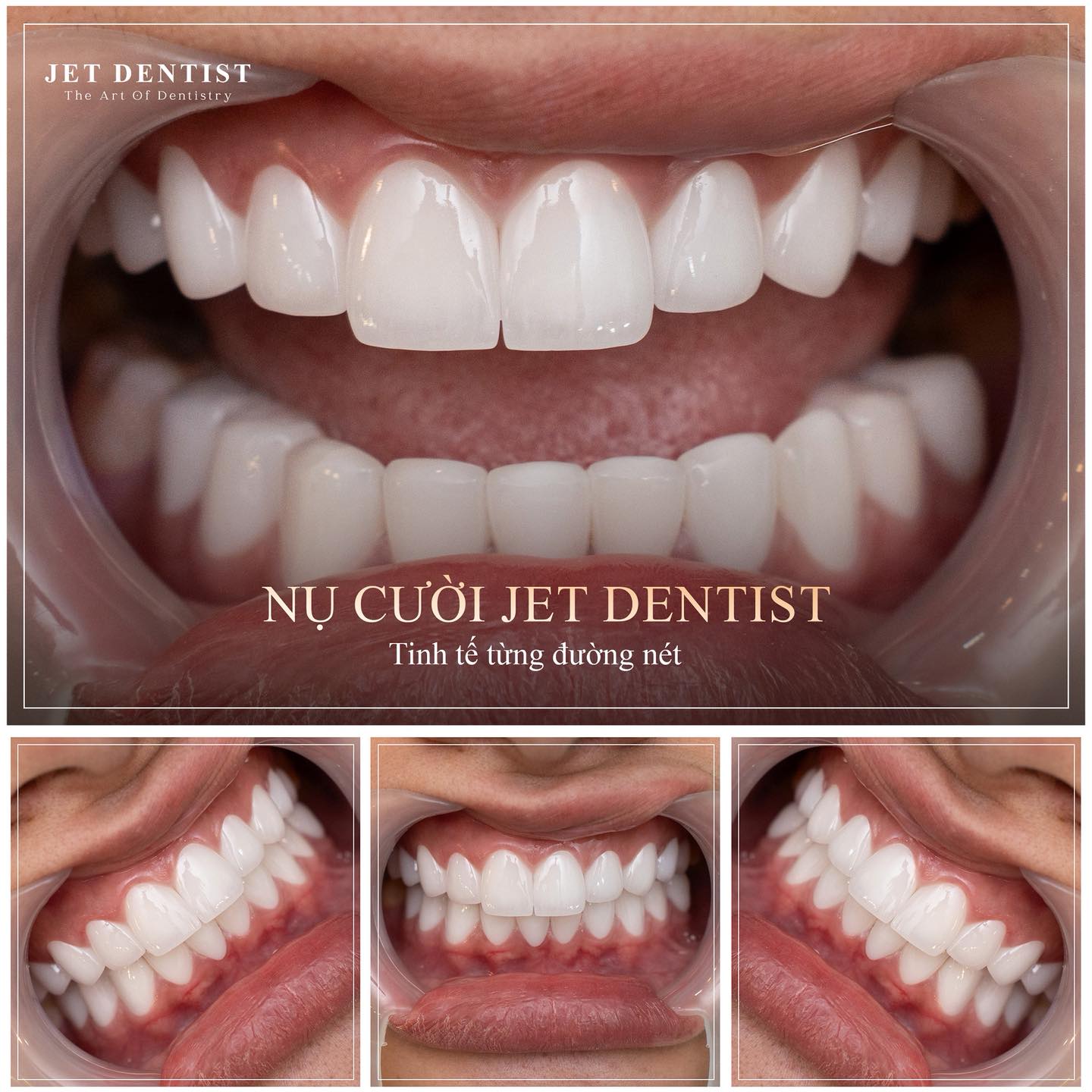 Jetdentist - Nha Khoa Thẩm Mỹ Hồ Chí Minh Facebook ad: NỤ CƯỜI JET DENTIST TINH TẾ TRONG TỪNG…