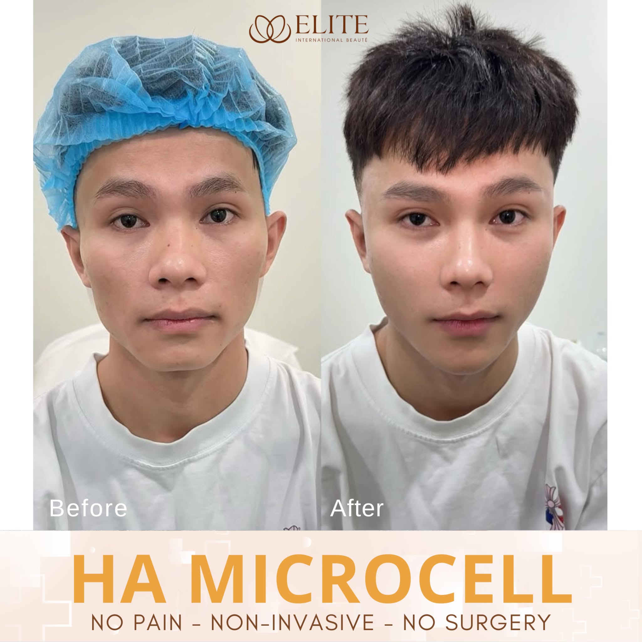 ELITE International Aesthetic Institute - Laguna Branch Facebook ad