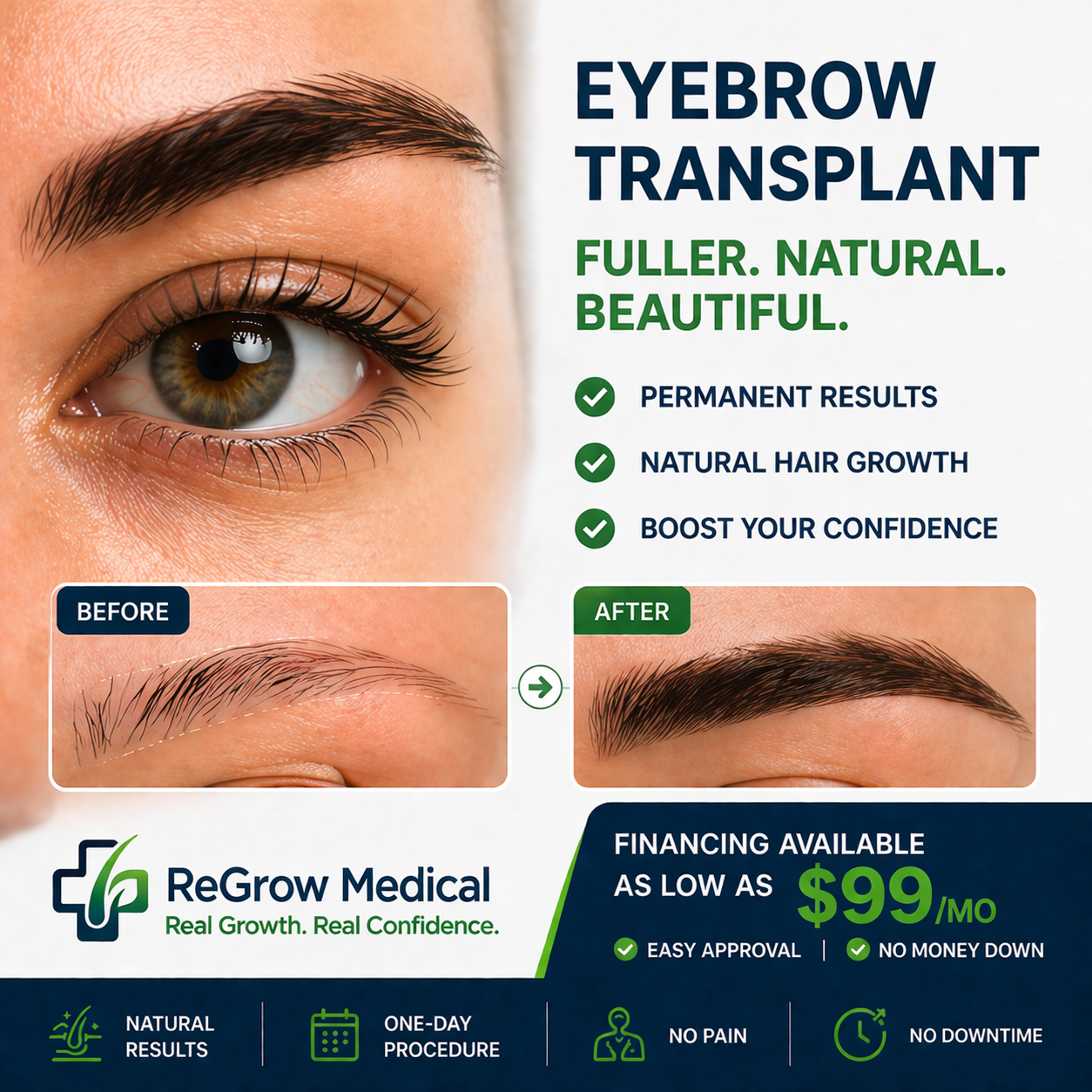 ReGrow Medical Facebook ad: FUE Eyebrow Transplant, Permanent. Natural. One Day.