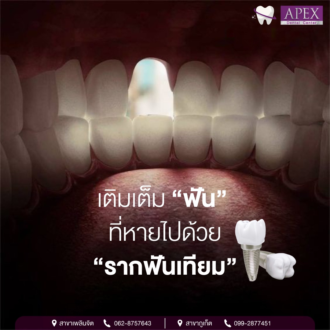 APEX Cosmetic Dental Phuket Facebook ad: แนะนำ ที่คุ้มค่า