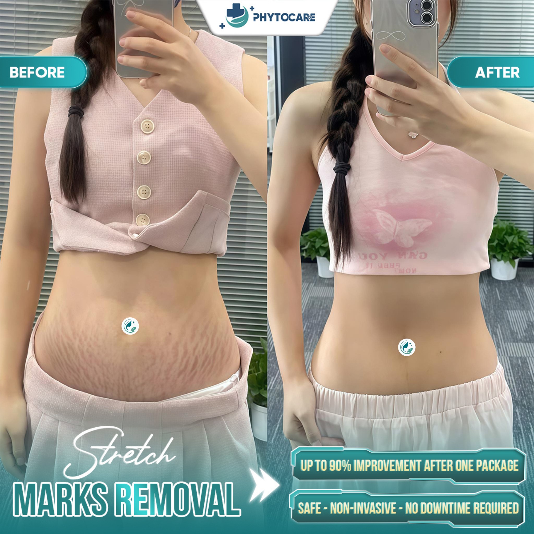 Phytocare Dermatology Cebu Facebook ad: ONE FULL PACKAGE FOR STRETCH MARKS REMOVAL AT…