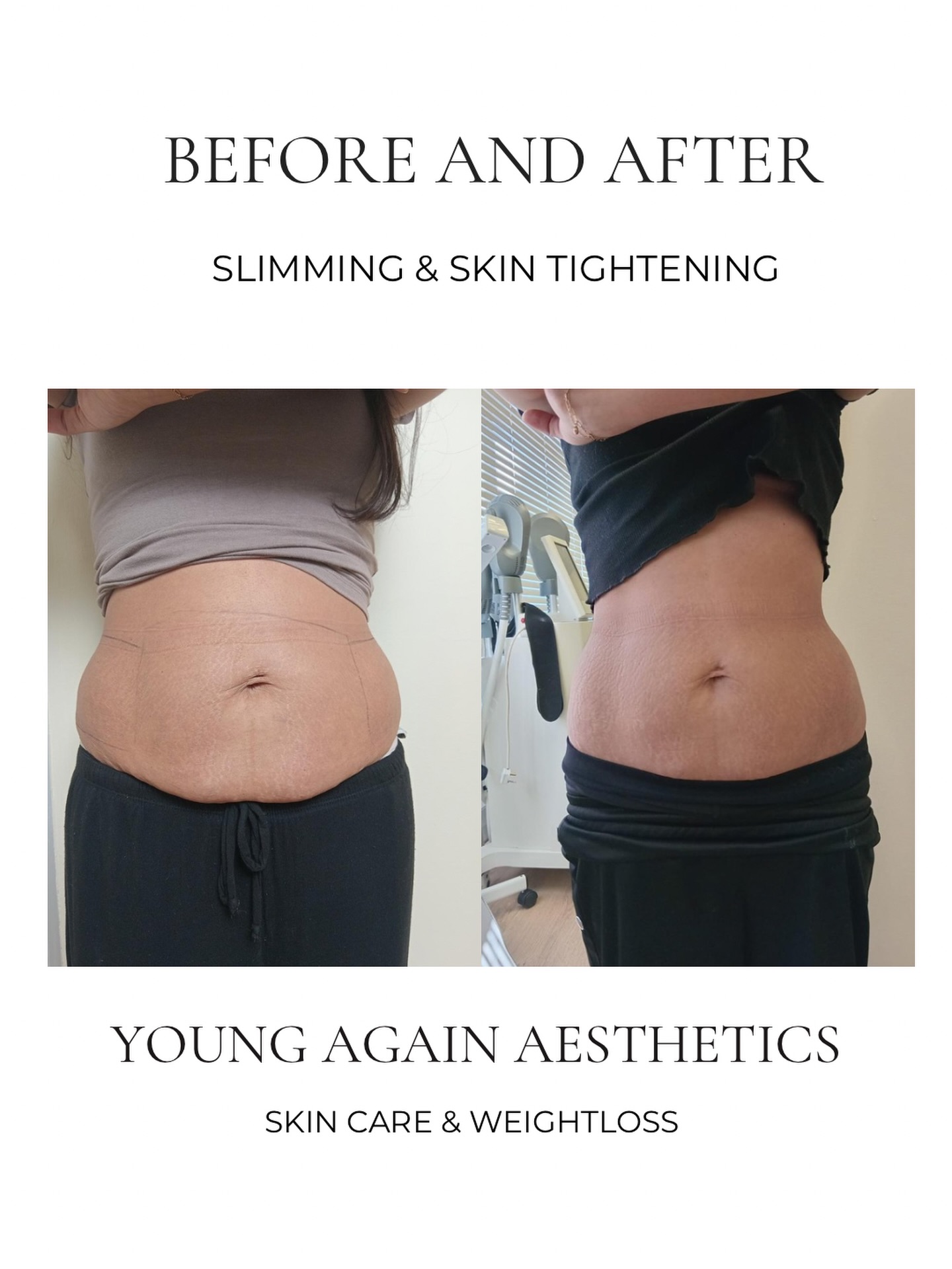 Young Again Aesthetics SA Facebook ad from Apr 17, 2026