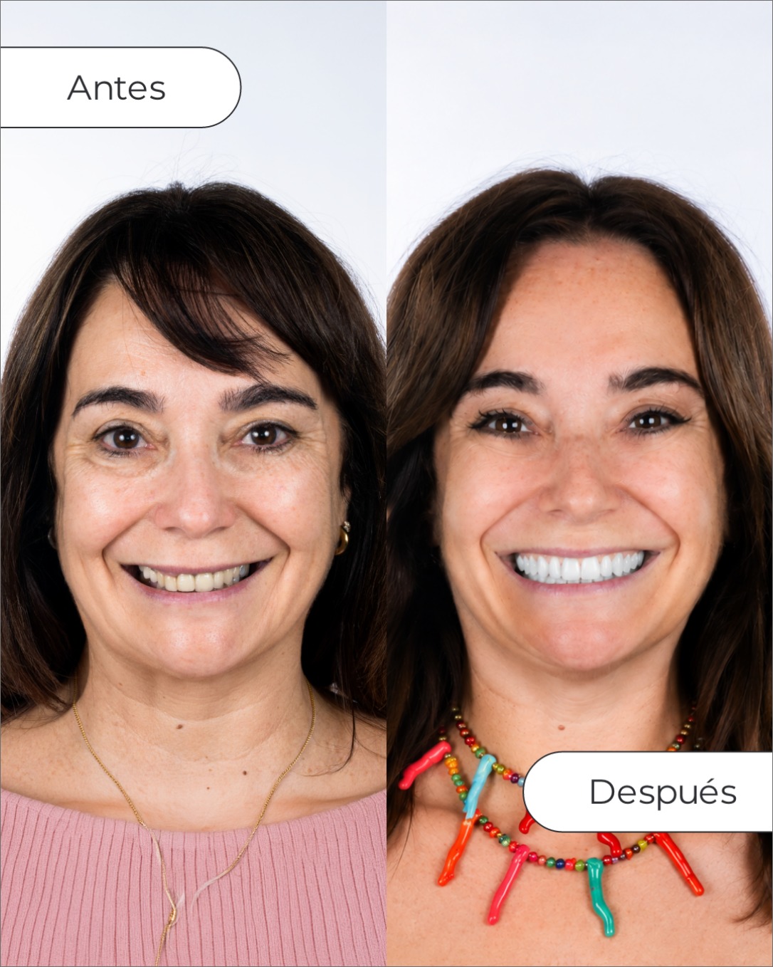 Vericat Implantología Inmediata. Clínica de implantes dentales. Facebook ad: El cambio de Matilde no consiste solo en…