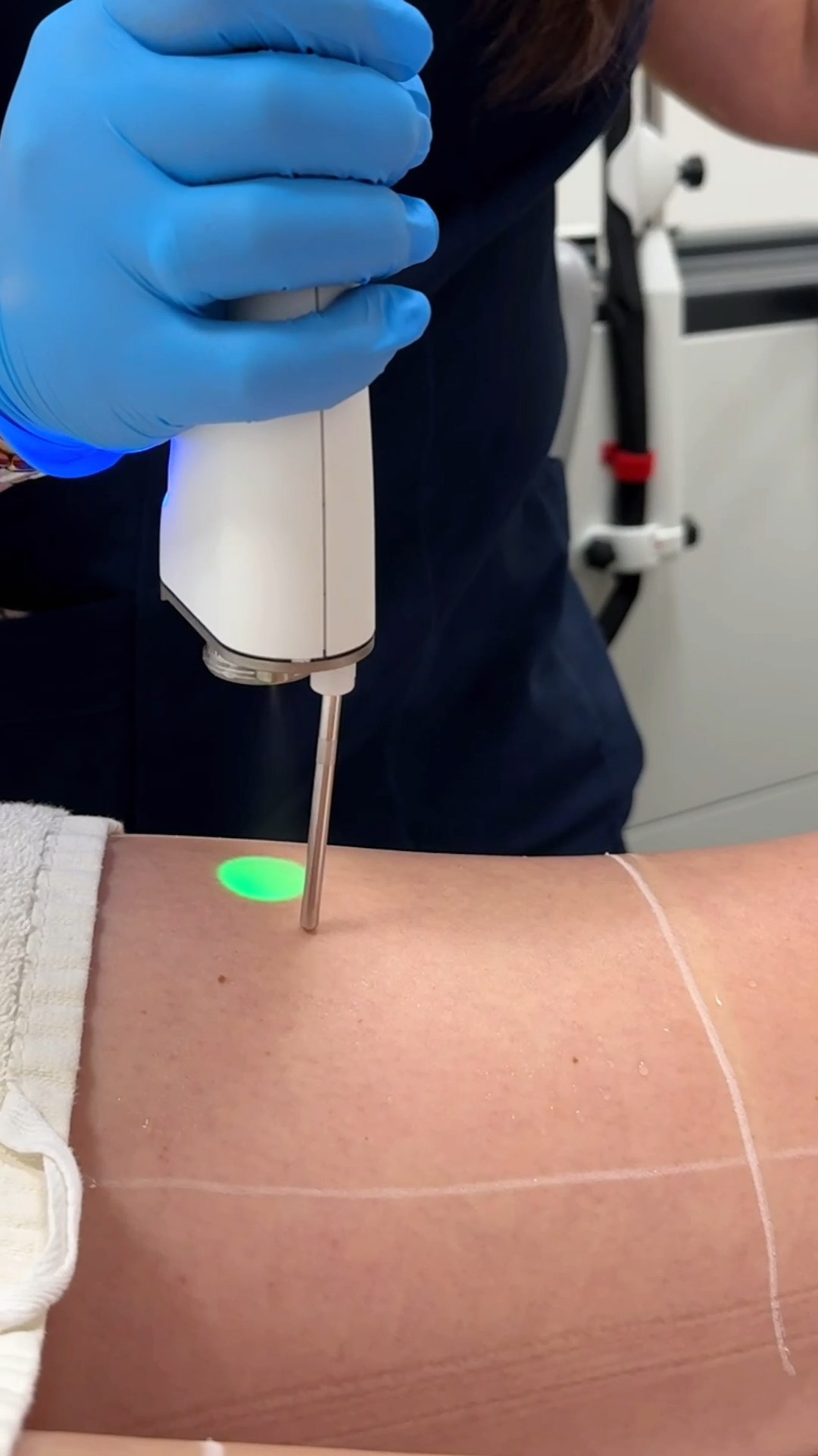 REVÙ CLINIC Facebook ad: Itin efektyvus Fotona Avalanche Aleksandrito lazeris!