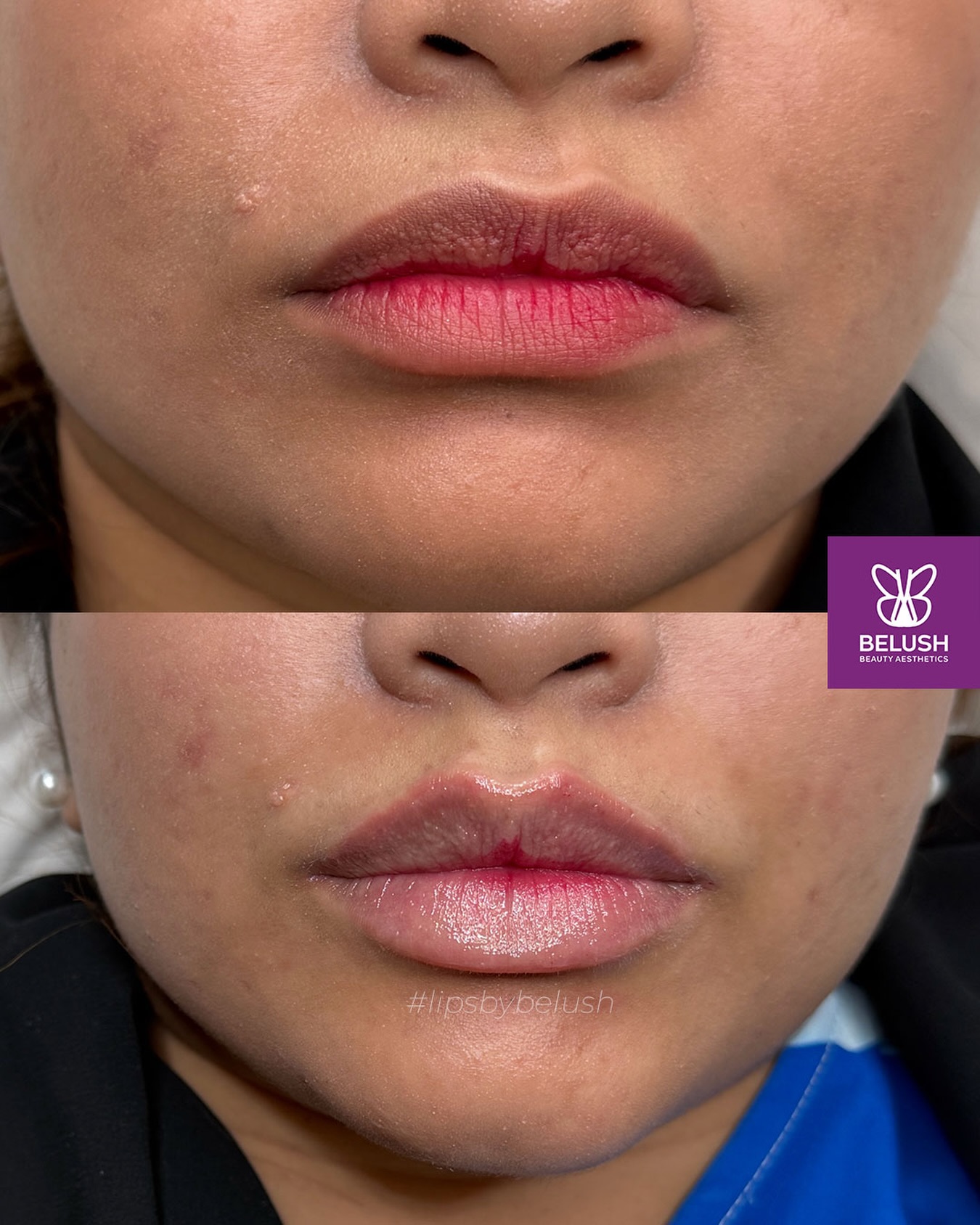 Belush Beauty Aesthetic 医美微整 Facebook ad: Many clients are scared of looking overdone and…