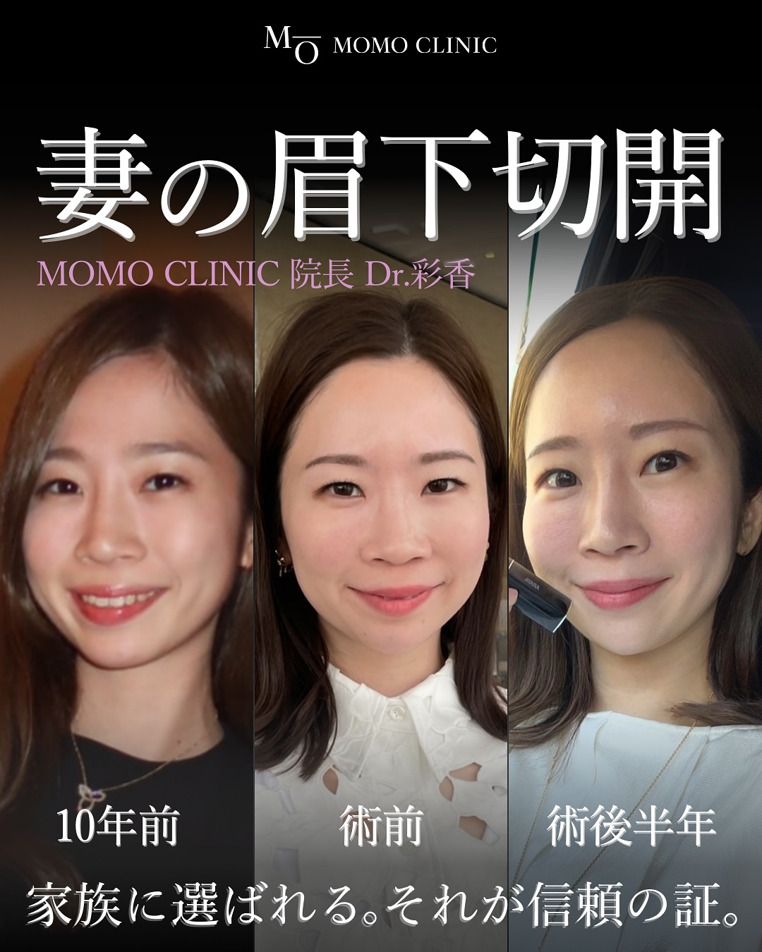Momo Clinic 大阪 Facebook ad: 眉下切開すれば10年前の新婚状態の妻になる