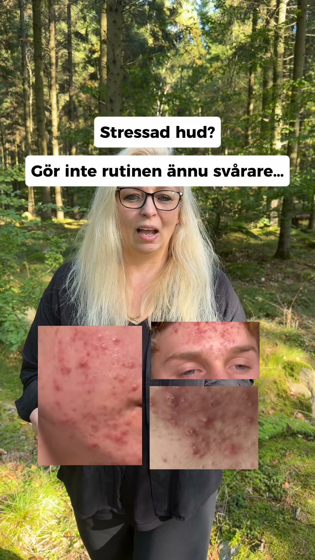 LovieBaby Facebook ad: Naturlig hudvård för akne
