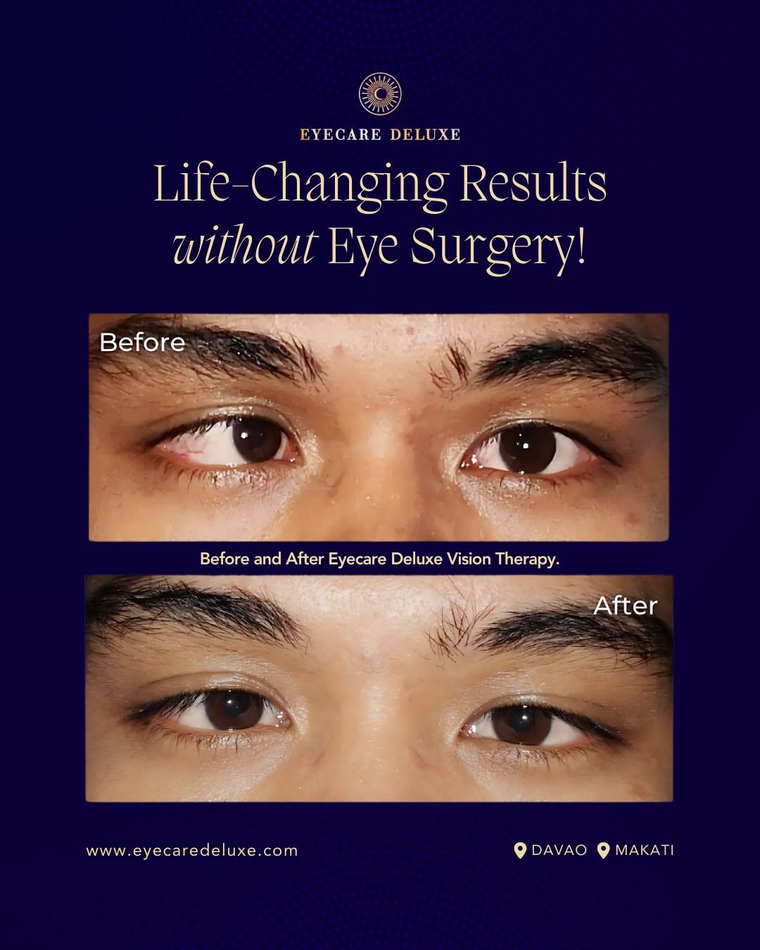 Eyecare Deluxe Facebook ad: ๐ฆ๐๐ฟ๐ฎ๐ฏ๐ถ๐๐บ๐๐ ๐๐ผ๐ฟ๐ฟ๐ฒ๐ฐ๐๐ถ๐ผ๐ป ๐ช๐ถ๐๐ต๐ผ๐๐โฆ