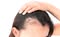 Hair Loss & Iron Deficiency