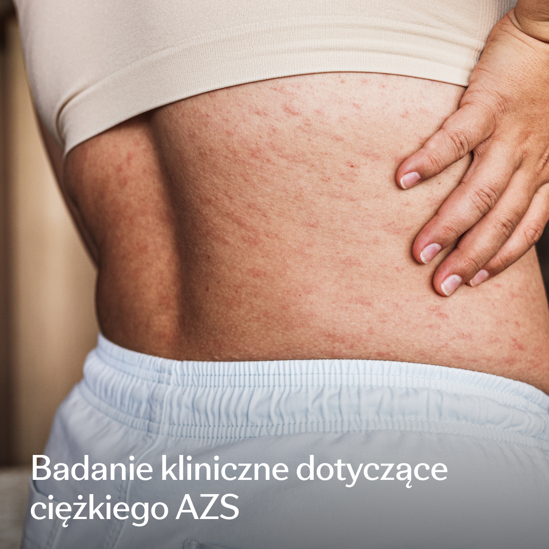 Eczema Research Study Facebook ad: Badania nad ciężkim AZS