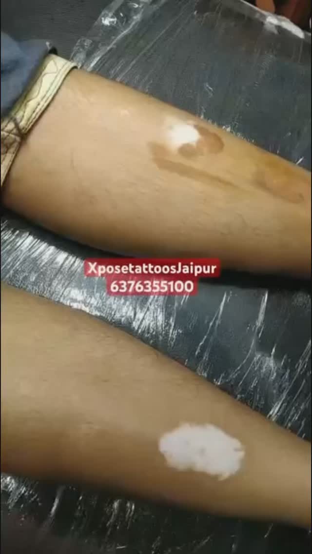 microvitiligo Facebook ad: Contact Us