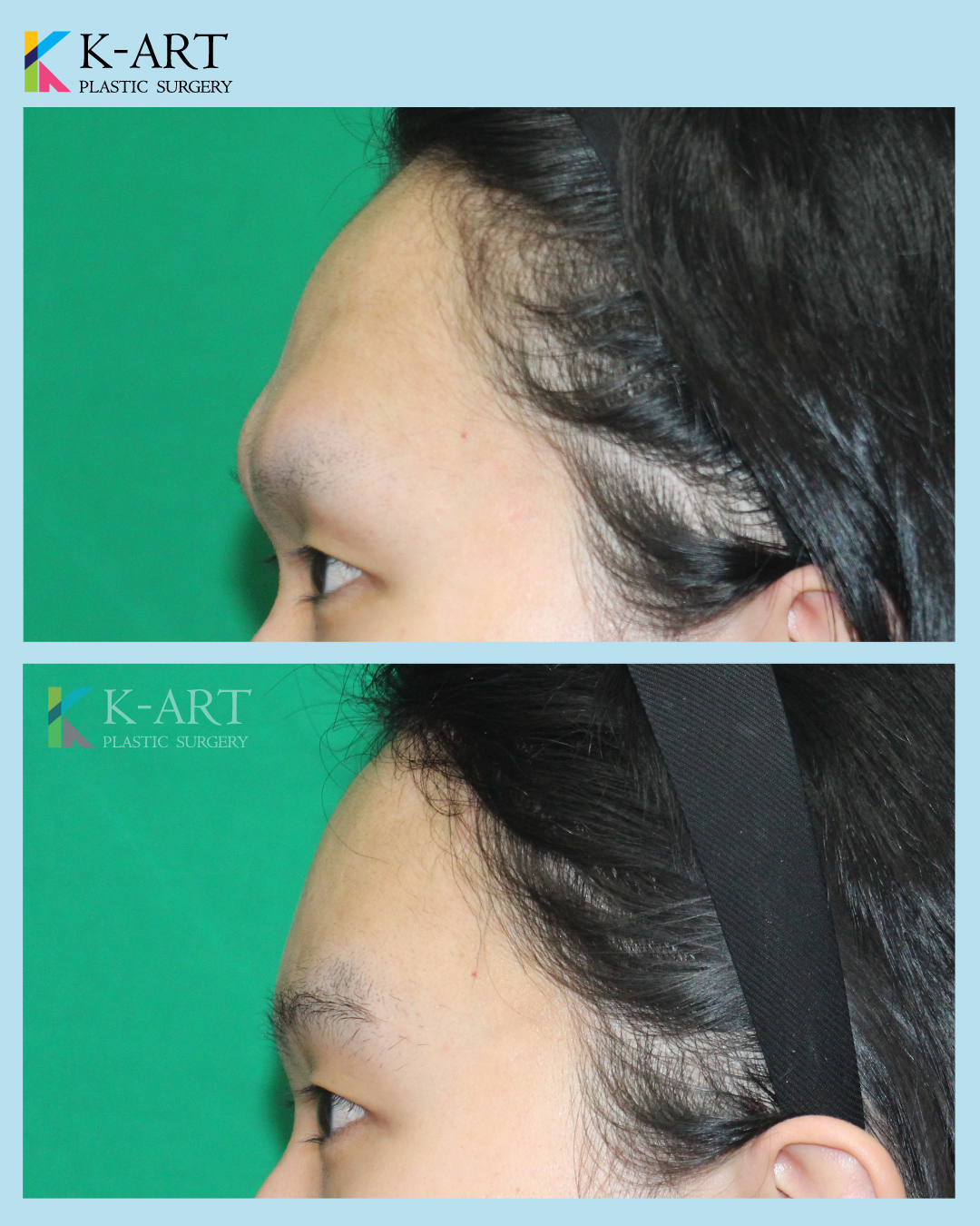 케이아트성형외과 Facebook ad: Facial Feminization