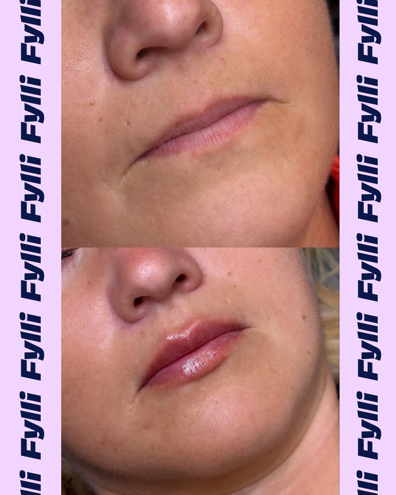 Fylli Facebook ad: liP fiLleRs alWayS loOk sO fAkE