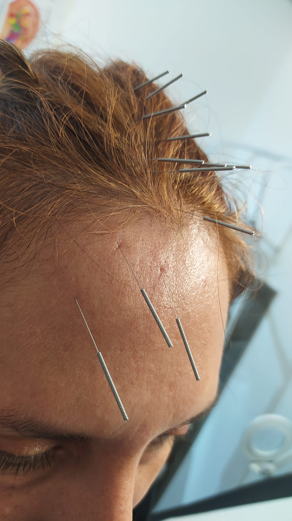 Studio Medico Dott. Nidal Al Yassin Facebook ad: La craniopuntura di Yamamoto, o Yamamoto New Scalp…