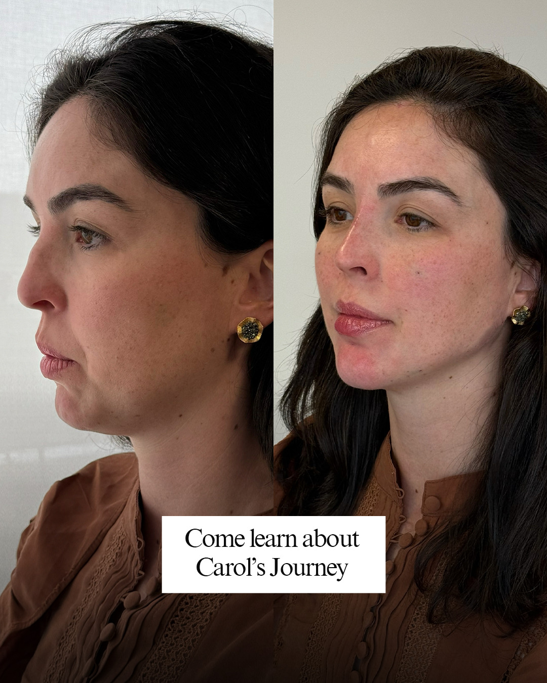 Rosele Aesthetics Facebook ad: When Carol first came in, she felt like…