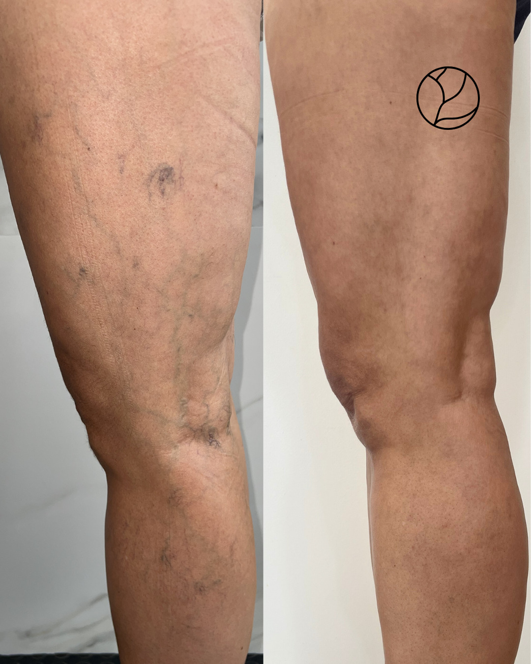 Dr. Luiz Eduardo - Vascular Facebook ad: Muitas pacientes convivem com o incômodo visual e…