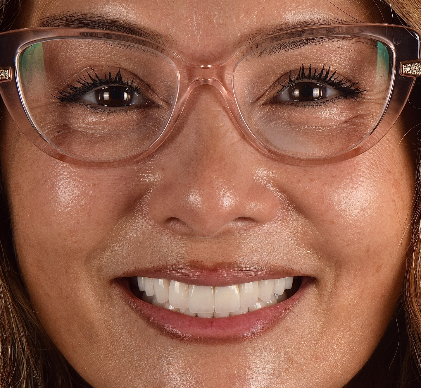 Dr. Birkan Duras Clinic Facebook ad: Life Changing Transformation with LDS Glass Ceramic Veneers…