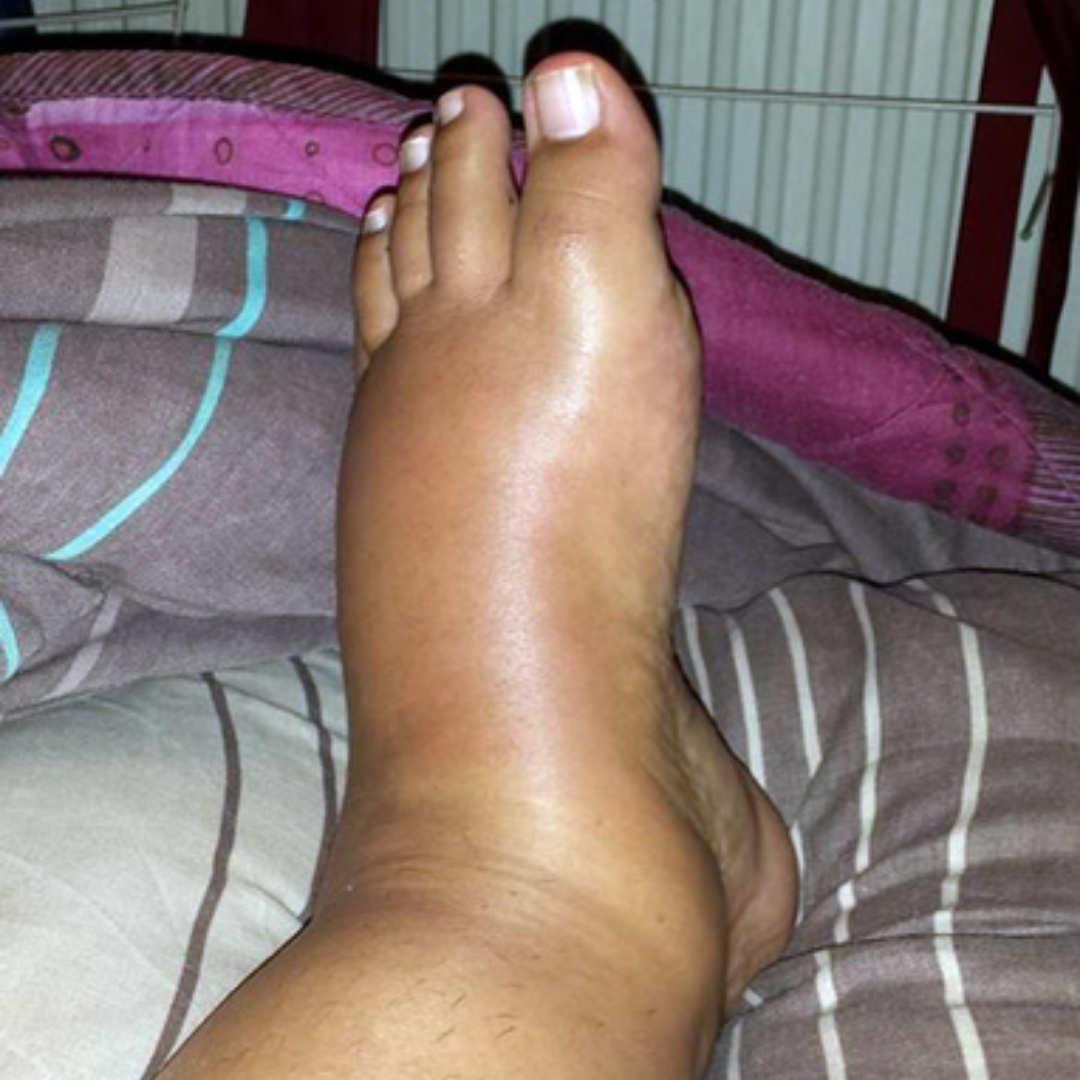 Megan Carter Facebook ad: I read this article about leg swelling…