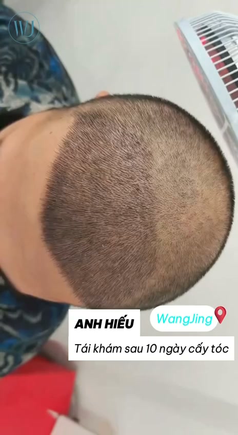 Viện Cấy Tóc Tự Thân WangJing DNA BioHair Facebook ad: VÙNG CẤY TÓC THAY ĐỔI RA SAO SAU…