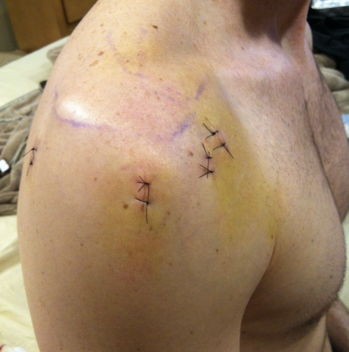 Jackson Miller Facebook ad: $25K SAVED ON SURGERY
