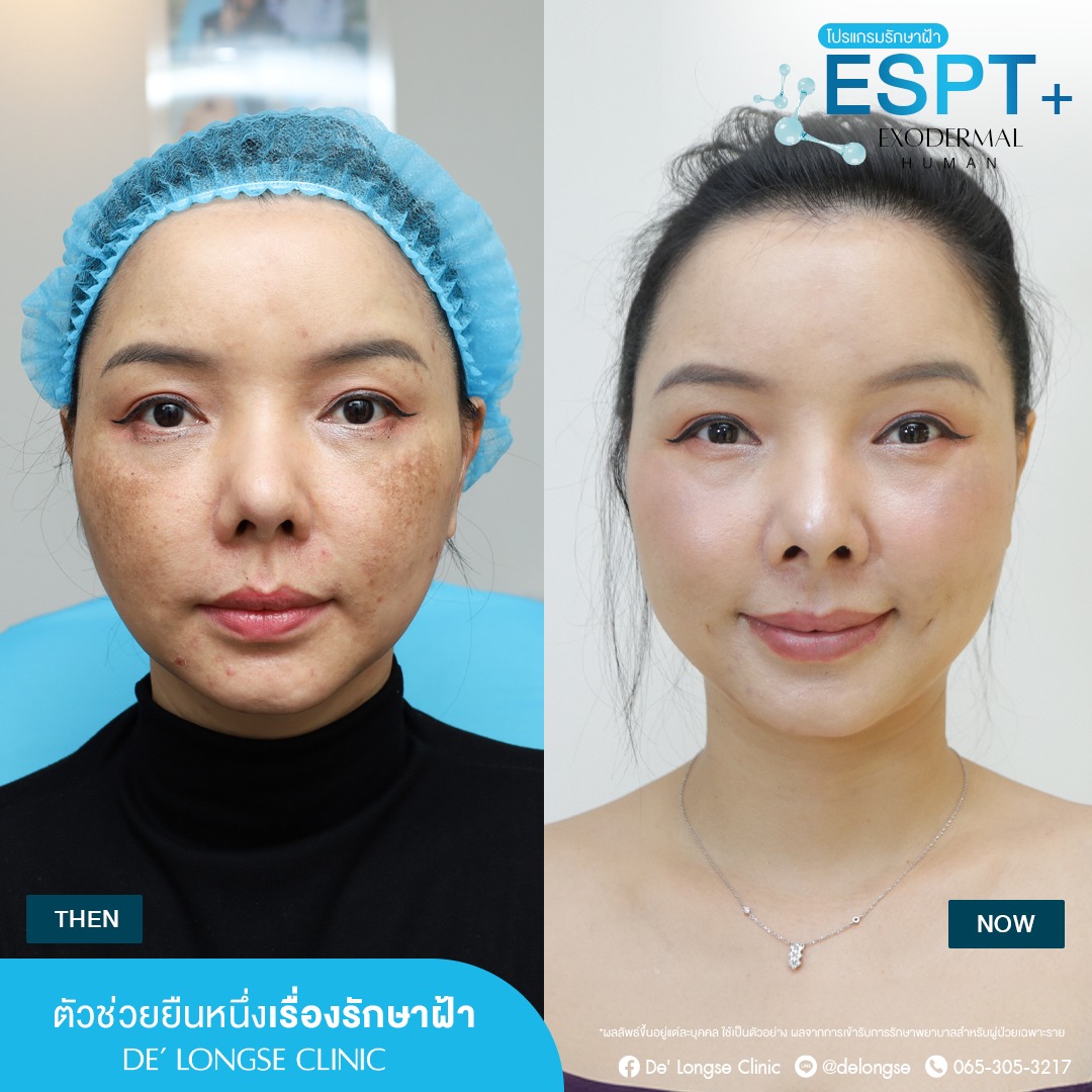 De' Longse Clinic คลินิกเเพทย์ผิวหนัง อโศก Facebook ad: ขจัดทุกรอยฝ้า ไม่ว่าว่าไหนก็เอาอยู่
