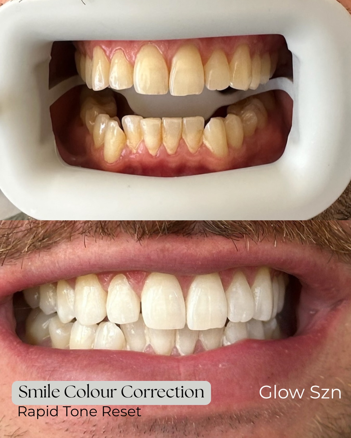 Glow SZN Facebook ad: Brighter Looking Teeth in One Appointment $250