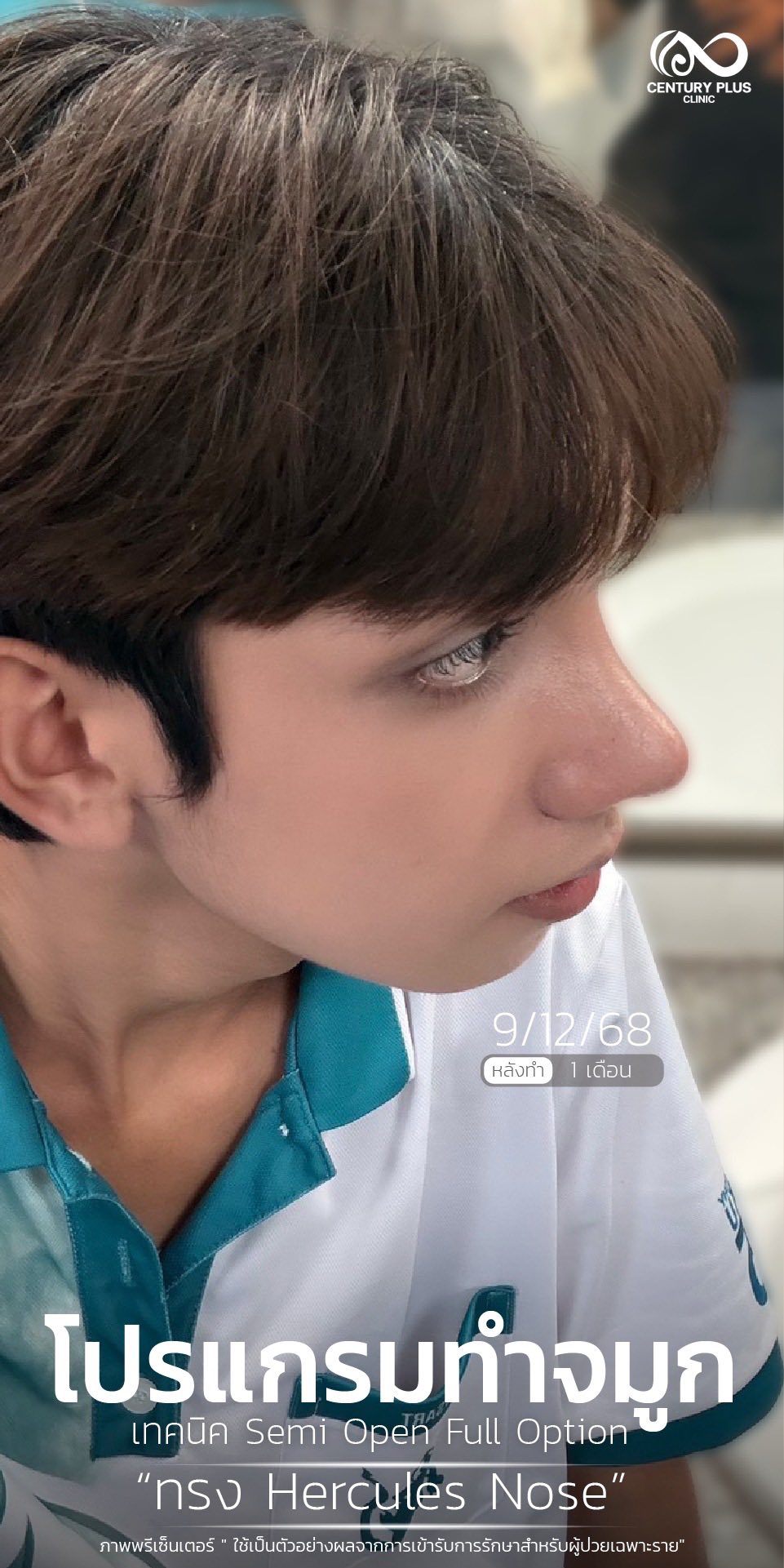Century Health Clinic Facebook ad: น้องนอสจากจมูกงุ้มในวันนั้น สู่จมูกทรง Hercules Nose…