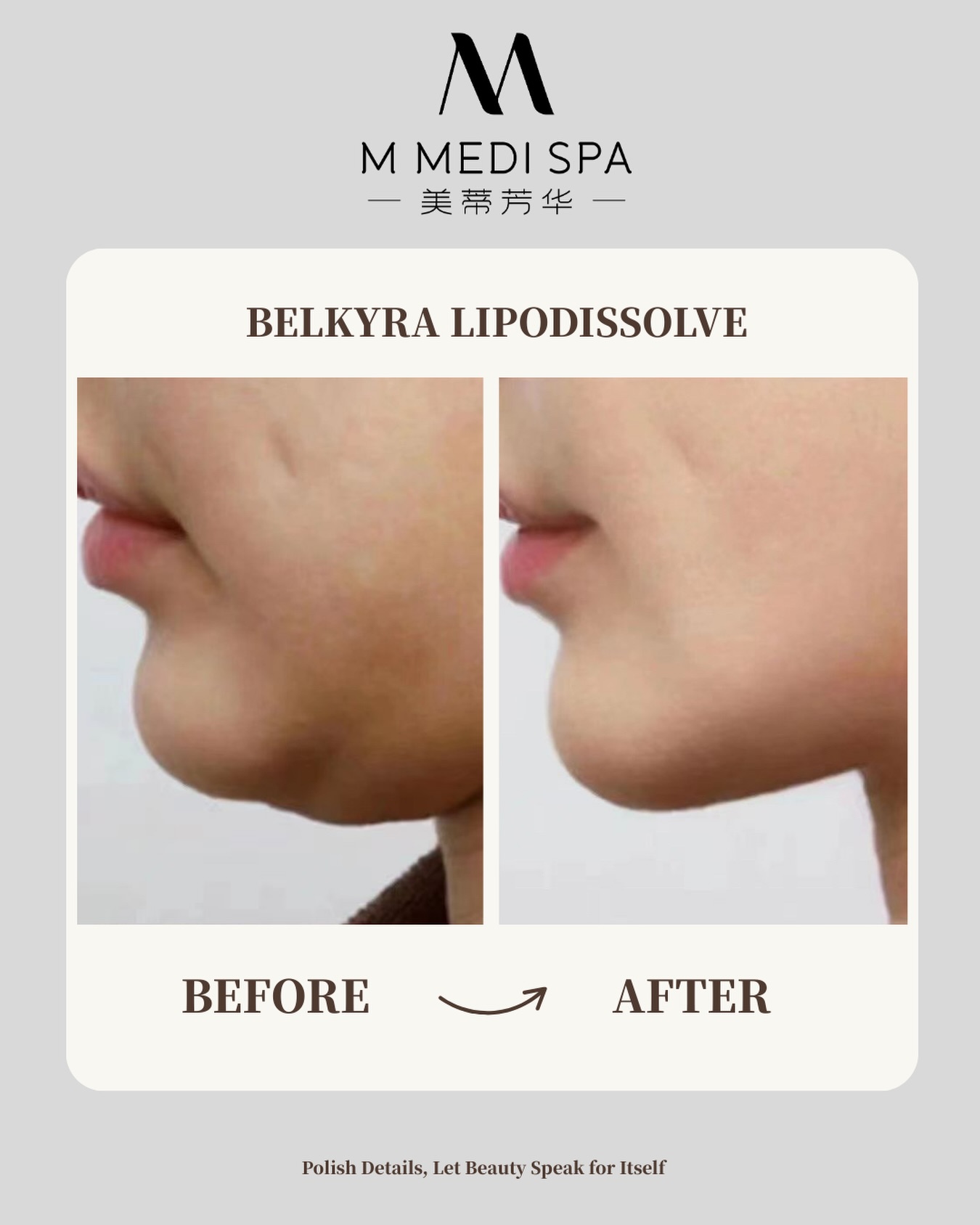M Medi Spa Ca Facebook ad: Double Chin Reduction | Non-Surgical